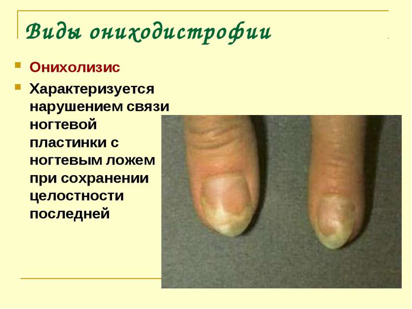 Виды ониходистрофии Онихолизис Характеризуется нарушением связи ногтевой плас...
