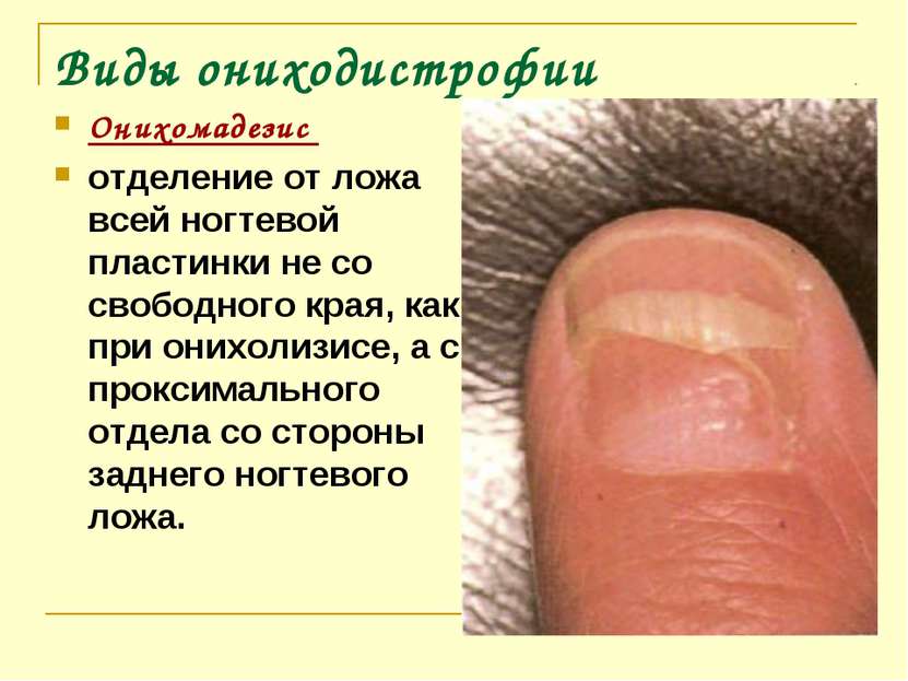 Виды ониходистрофии Онихомадезис отделение от ложа всей ногтевой пластинки не...