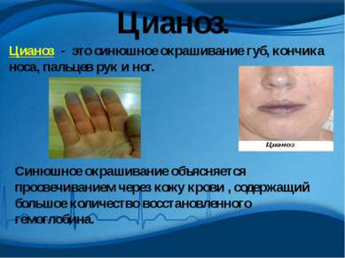 Цианоз. Цианоз - это синюшное окрашивание губ, кончика носа, пальцев рук и но...