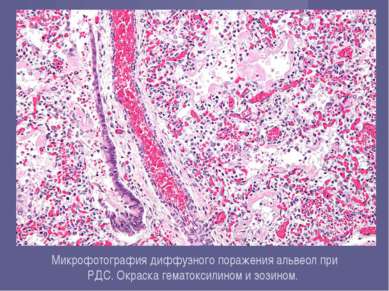 Микрофотография диффузного поражения альвеол при РДС. Окраска гематоксилином ...
