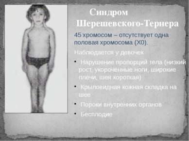 Синдром Шерешевского-Тернера 45 хромосом – отсутствует одна половая хромосома...