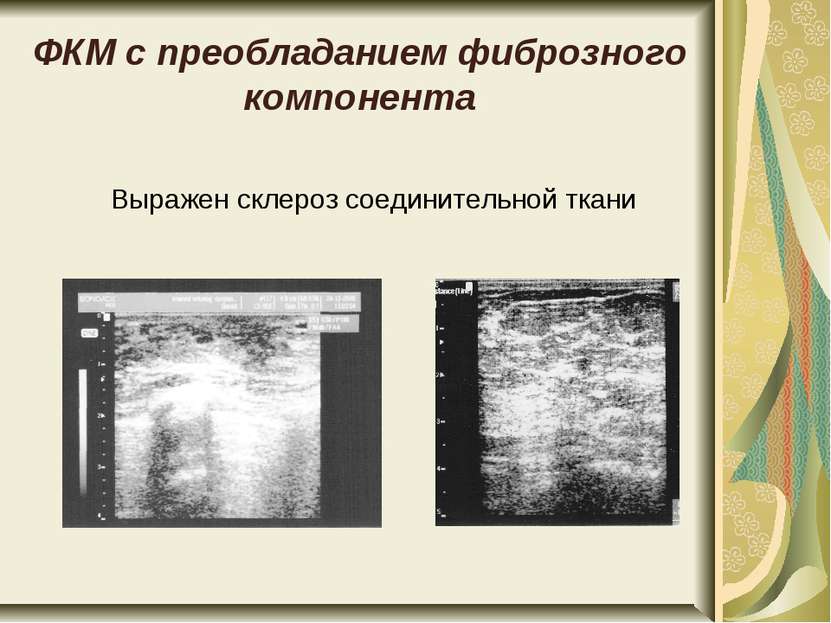 ФКМ с преобладанием фиброзного компонента Выражен склероз соединительной ткани