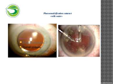 Phacoemulsification cataract «with water» Alexander Schweiker, MD Paris, ESCR...