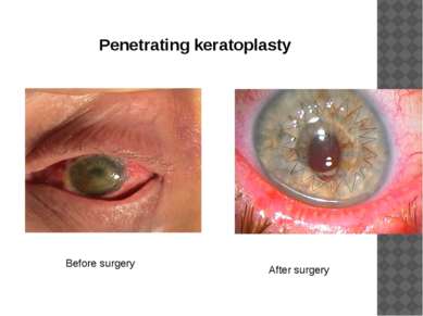 Penetrating keratoplasty Before surgery After surgery