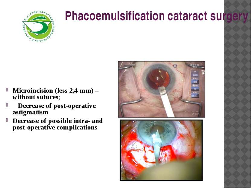 Phacoemulsification cataract surgery   Microincision (less 2,4 mm) – without ...