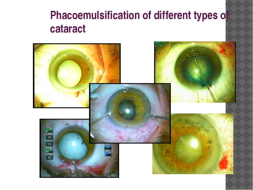 Phacoemulsification of different types of cataract