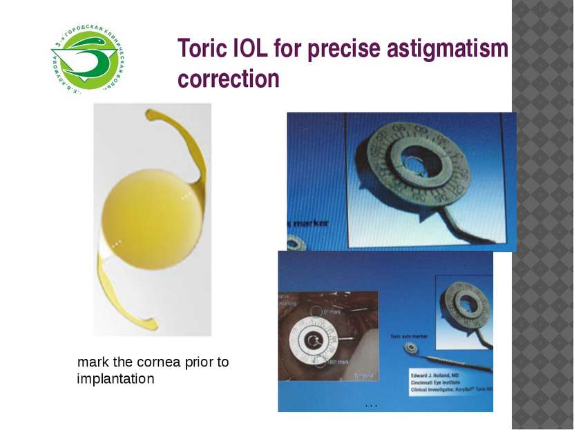 Toric IOL for precise astigmatism correction  mark the cornea prior to implan...