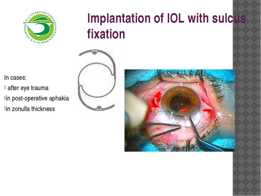 Implantation of IOL with sulcus fixation In cases: after eye trauma in post-o...