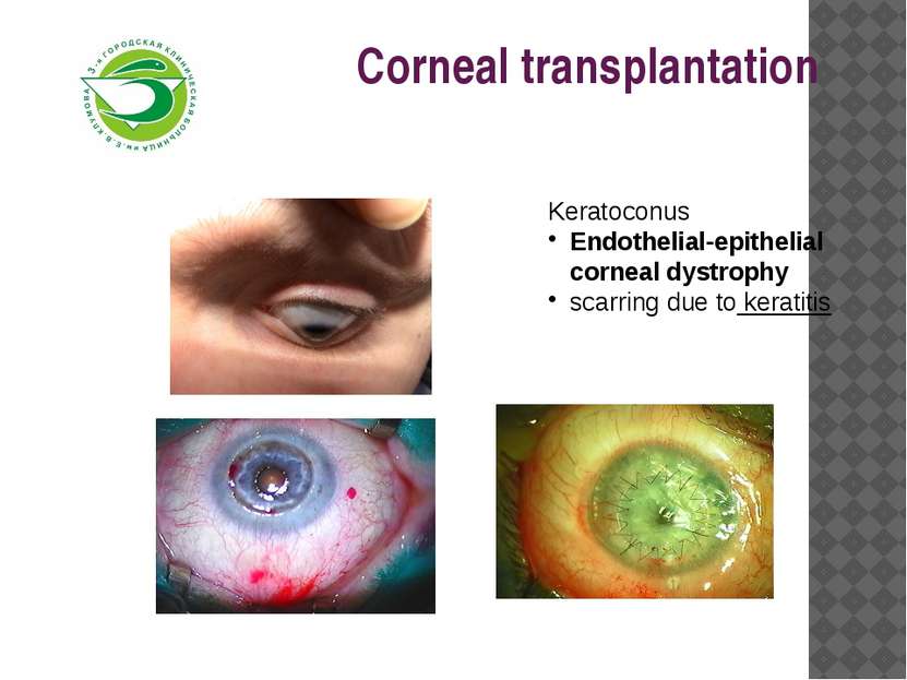 Corneal transplantation Keratoconus Endothelial-epithelial corneal dystrophy ...