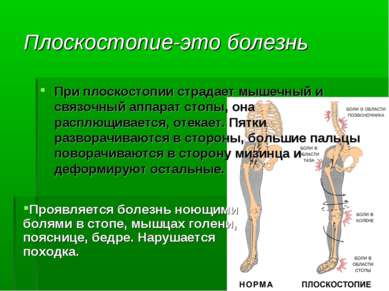Плоскостопие-это болезнь При плоскостопии страдает мышечный и связочный аппар...