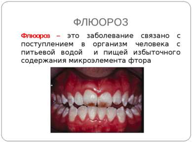 ФЛЮОРОЗ Флюороз – это заболевание связано с поступлением в организм человека ...