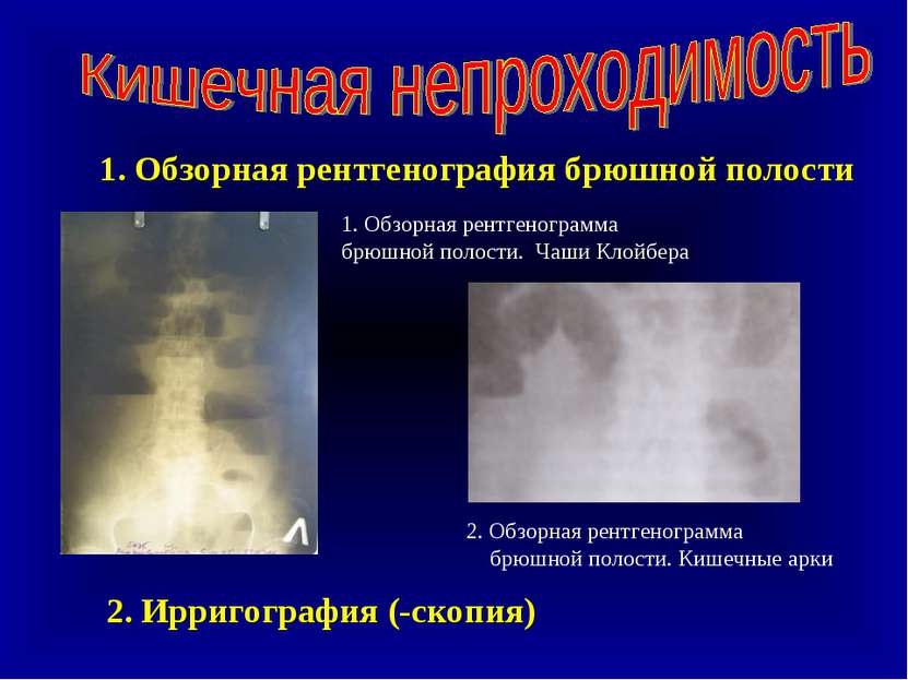1. Обзорная рентгенография брюшной полости 1. Обзорная рентгенограмма брюшной...