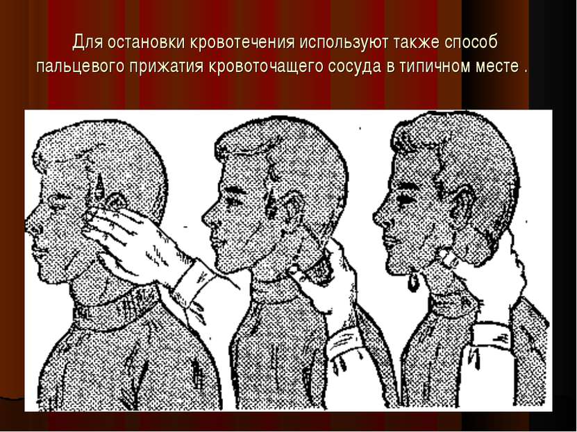 Для остановки кровотечения используют также способ пальцевого прижатия кровот...