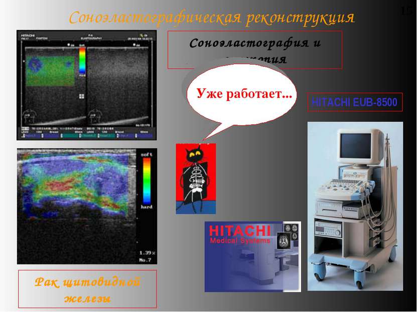 Соноэластографическая реконструкция 15 Соноэластография и эхоскопия Рак щитов...