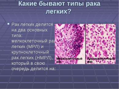 Какие бывают типы рака легких? Рак легких делится на два основных типа: мелко...