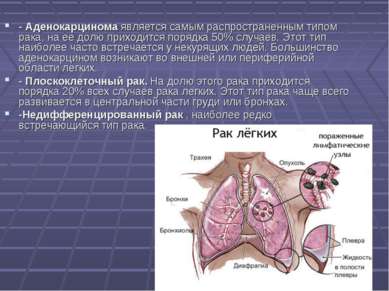 - Аденокарцинома является самым распространенным типом рака, на ее долю прихо...