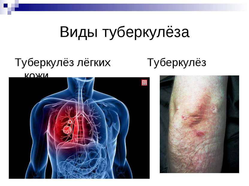 Виды туберкулёза Туберкулёз лёгких Туберкулёз кожи