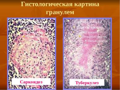 Гистологическая картина гранулем Саркоидоз Туберкулез