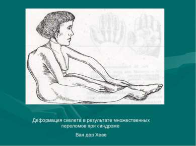 Деформация скелета в результате множественных переломов при синдроме Ван дер ...