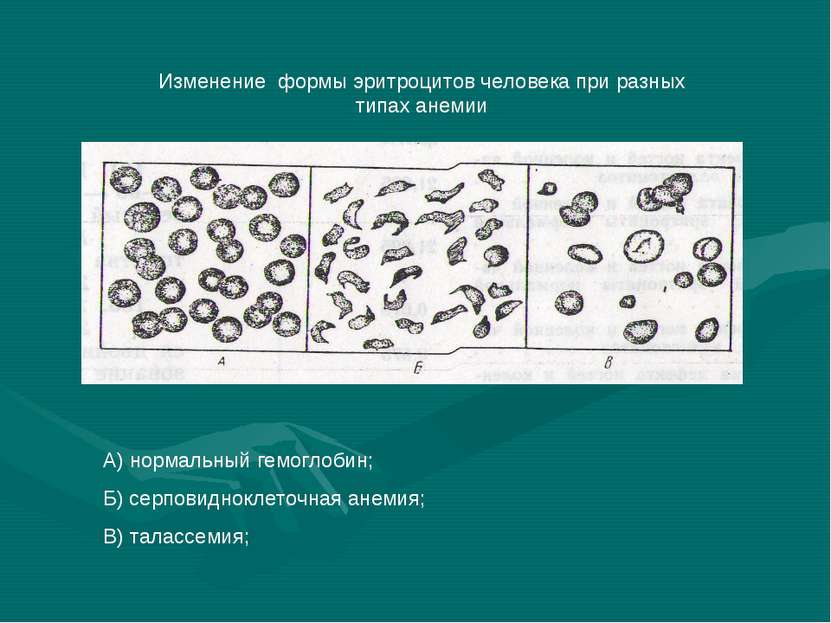 Изменение формы эритроцитов человека при разных типах анемии А) нормальный ге...