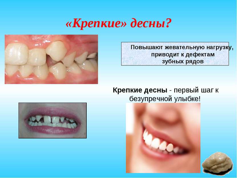 «Крепкие» десны? Повышают жевательную нагрузку, приводит к дефектам зубных ря...