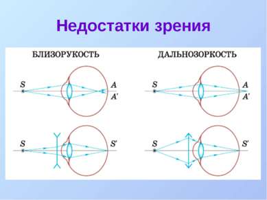 Недостатки зрения