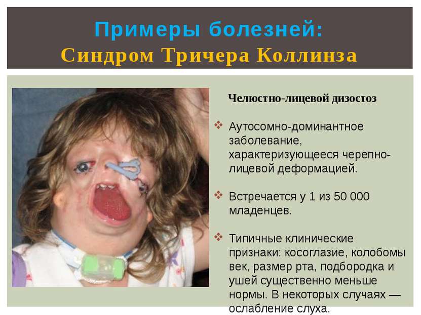 Примеры болезней: Синдром Тричера Коллинза Челюстно-лицевой дизостоз Аутосомн...