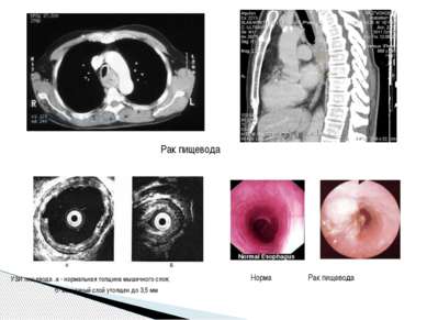 УЗИ пищевода .а - нормальная толщина мышечного слоя; б- мышечный слой утолщен...