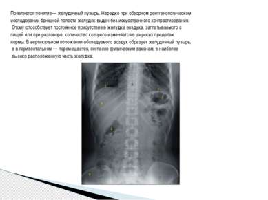 Появляется понятие— желудочный пузырь. Нередко при обзорном рентгенологическо...