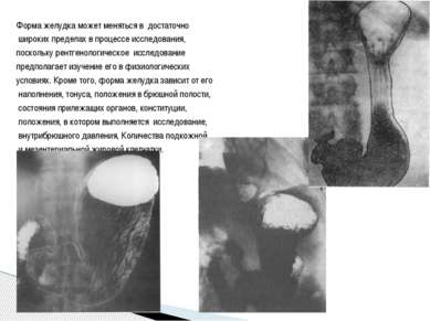 Форма желудка может меняться в достаточно широких пределах в процессе исследо...