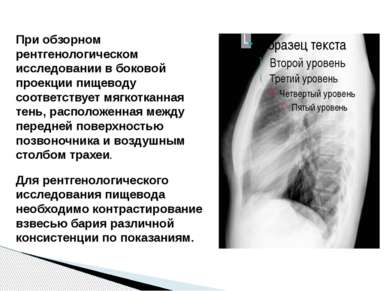 При обзорном рентгенологическом исследовании в боковой проекции пищеводу соот...