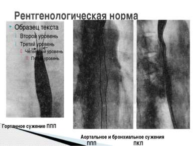 Рентгенологическая норма Гортанное сужение ППП Аортальное и бронхиальное суже...