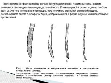 После приема контрастной массы сначала контурируются стенки и карманы глотки,...