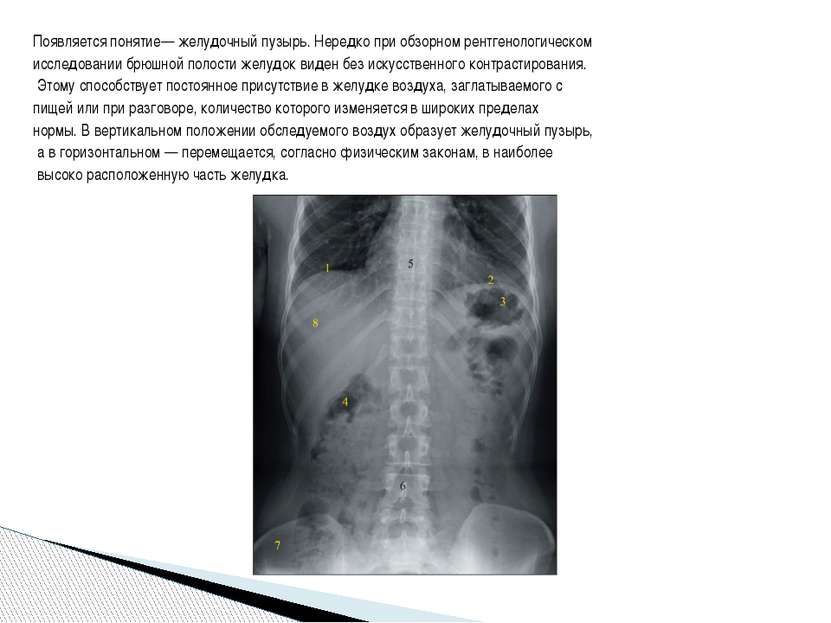 Появляется понятие— желудочный пузырь. Нередко при обзорном рентгенологическо...