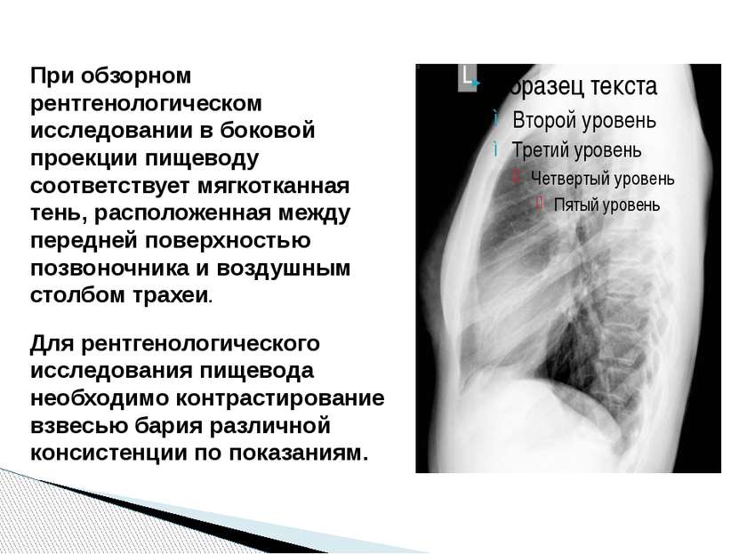 При обзорном рентгенологическом исследовании в боковой проекции пищеводу соот...