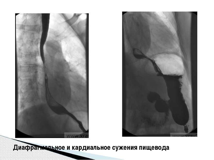 Диафрагмальное и кардиальное сужения пищевода