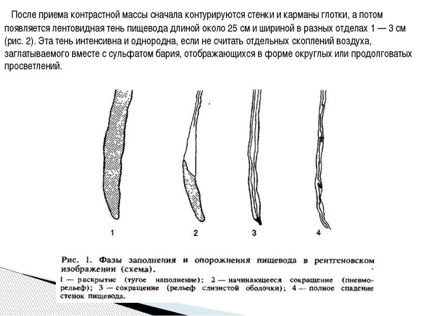 После приема контрастной массы сначала контурируются стенки и карманы глотки,...