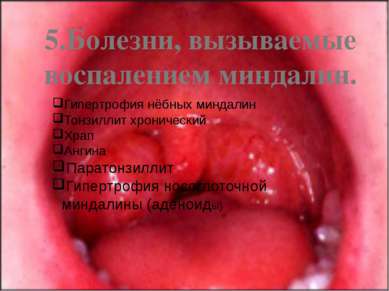 5.Болезни, вызываемые воспалением миндалин. Гипертрофия нёбных миндалин Тонзи...