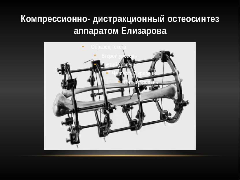 Компрессионно- дистракционный остеосинтез аппаратом Елизарова