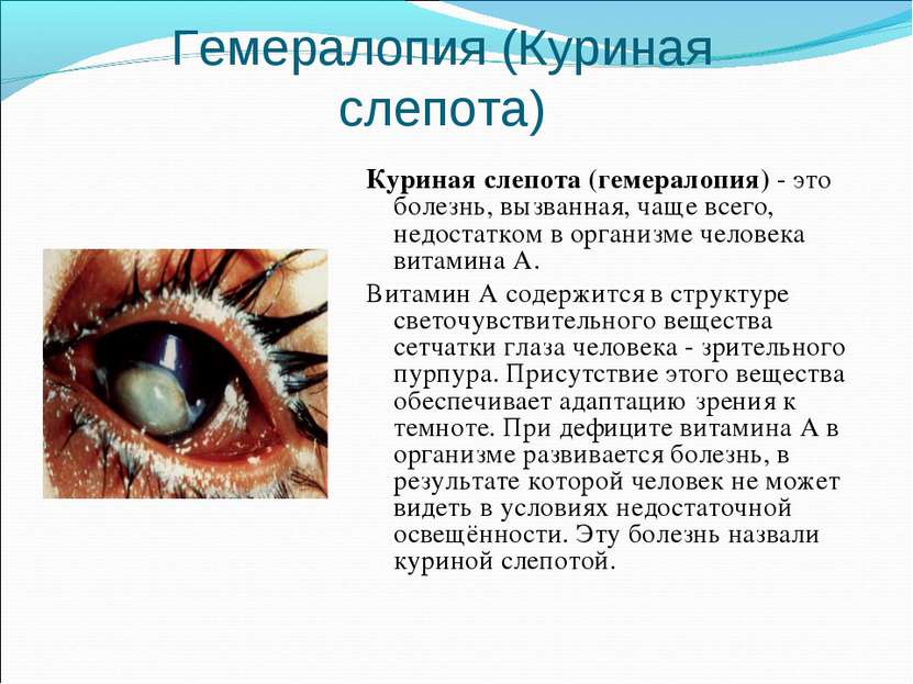 Гемералопия (Куриная слепота) Куриная слепота (гемералопия) - это болезнь, вы...