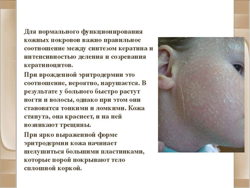 Эритродермия Для нормального функционирования кожных покровов важно правильно...