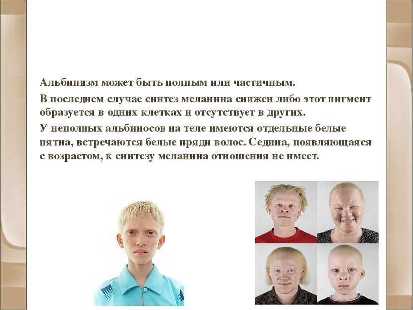 Альбинизм и другие нарушения пигментации Альбинизм может быть полным или част...