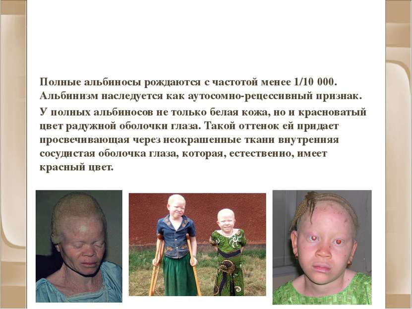 Альбинизм и другие нарушения пигментации Полные альбиносы рождаются с частото...
