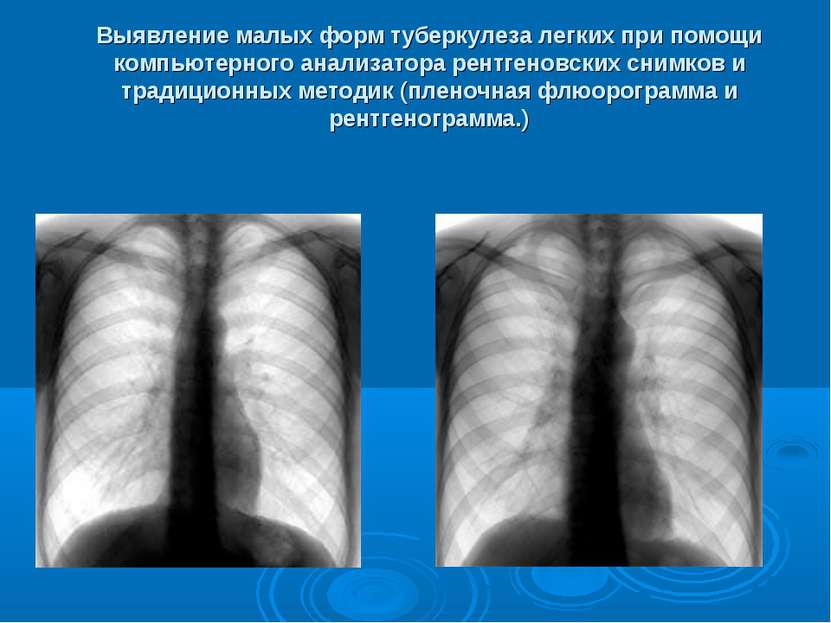 Выявление малых форм туберкулеза легких при помощи компьютерного анализатора ...