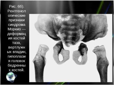 Рис. 6б). Рентгенологические признаки синдрома Моркио — деформация костей таз...