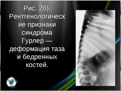 Рис. 2б). Рентгенологические признаки синдрома Гурлер — деформация таза и бед...