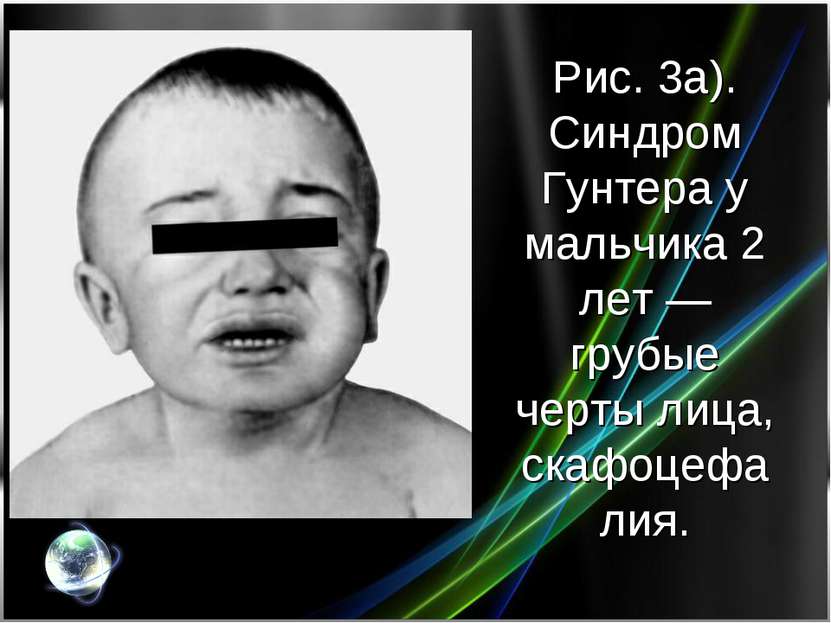 Рис. 3а). Синдром Гунтера у мальчика 2 лет — грубые черты лица, скафоцефалия.
