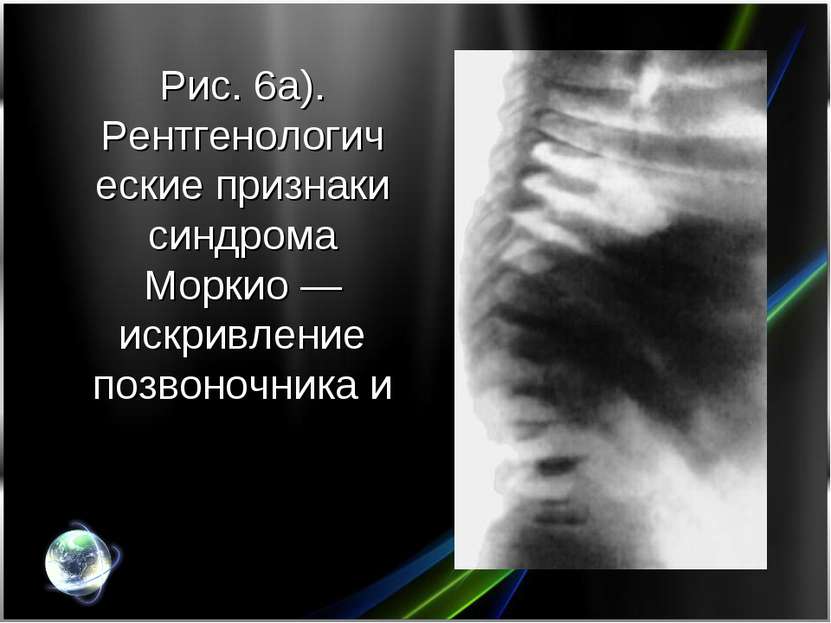 Рис. 6а). Рентгенологические признаки синдрома Моркио — искривление позвоночн...
