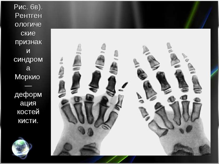 Рис. 6в). Рентгенологические признаки синдрома Моркио — деформация костей кисти.