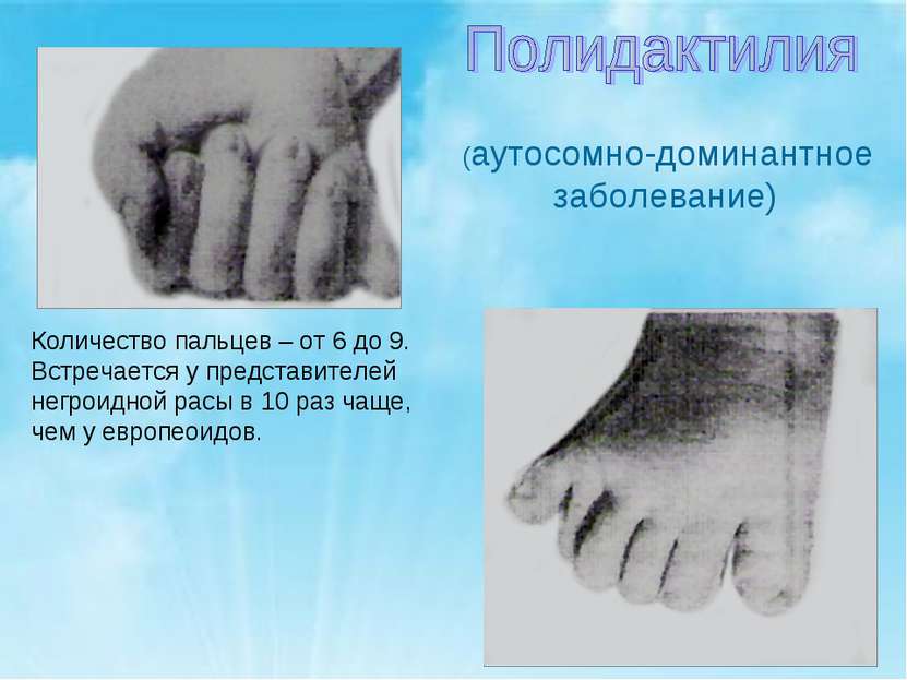 (аутосомно-доминантное заболевание) Количество пальцев – от 6 до 9. Встречает...